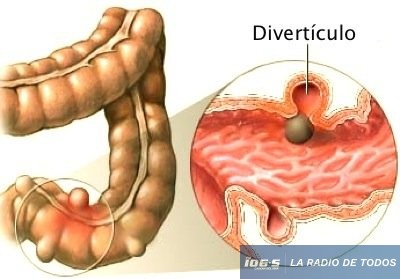 DIVERTICULITIS