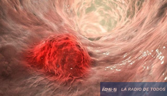 CANCER COLORRECTAL