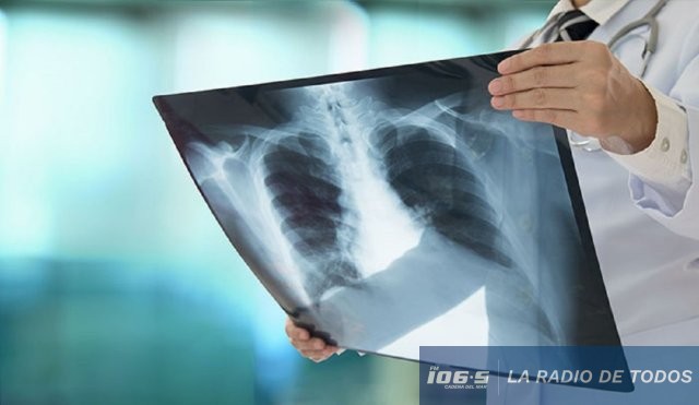 tuberculosis