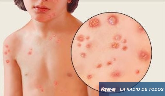 VARICELA