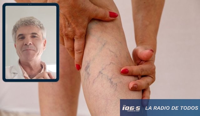 varices