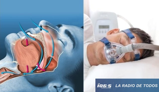 APNEA 1